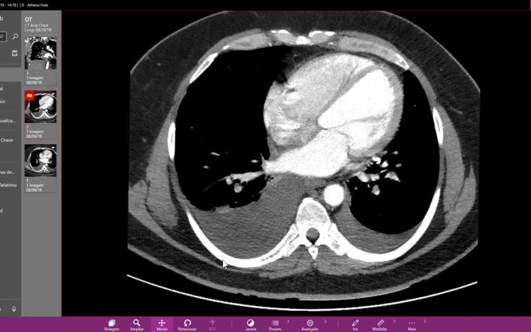 Pulmonary Embolism: What is it and how to use a DICOM Viewer to diagnose?